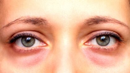 hotel-waag-makkum-het-is-niet-altijd-vermoeidheid-een-expert-legt-uit-waarom-je-kringen-hebt-onder-d