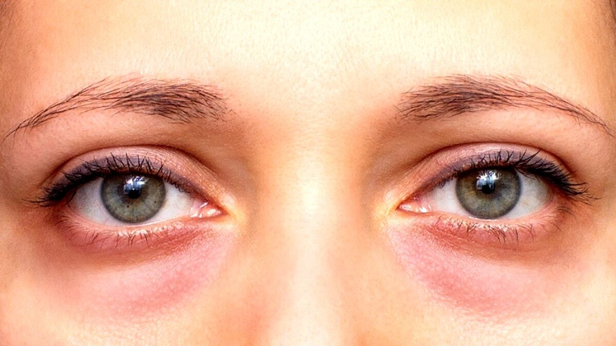 hotel-waag-makkum-het-is-niet-altijd-vermoeidheid-een-expert-legt-uit-waarom-je-kringen-hebt-onder-d